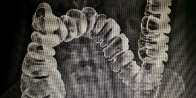 colonscopia virtuale tomografia computerizzata CT