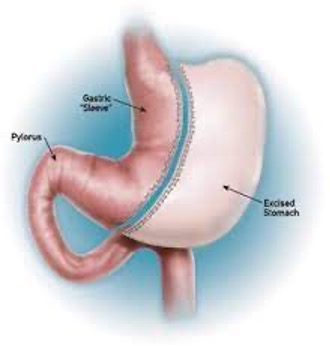Sleeve gastrectomy