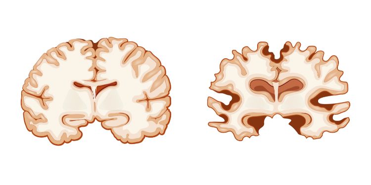 Morbo di Alzheimer